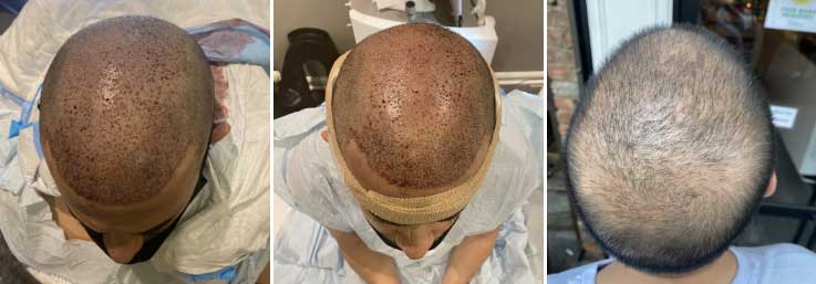 Are You Ready to Make the Commitment to a Hair Transplant in New York? post thumbnail image
