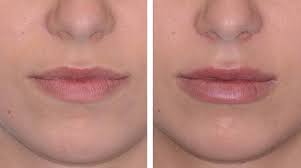 How to Prepare for Lip Fillers Santa Barbara Treatment post thumbnail image