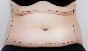 Combining Abdominoplasty with Other Procedures in Miami: A Trending Approach post thumbnail image